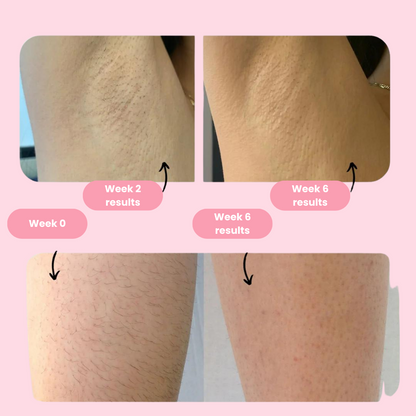 Royal IPL | Permanent Hair Removal