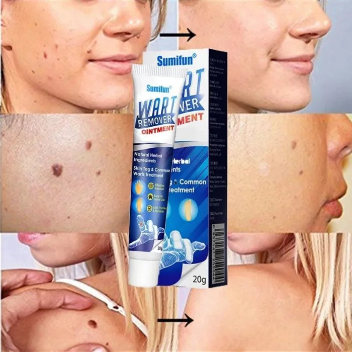 Wartsprotec® Tratamiento para pecas, manchas y Verrugas